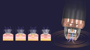 Does RF Microneedling Hurt